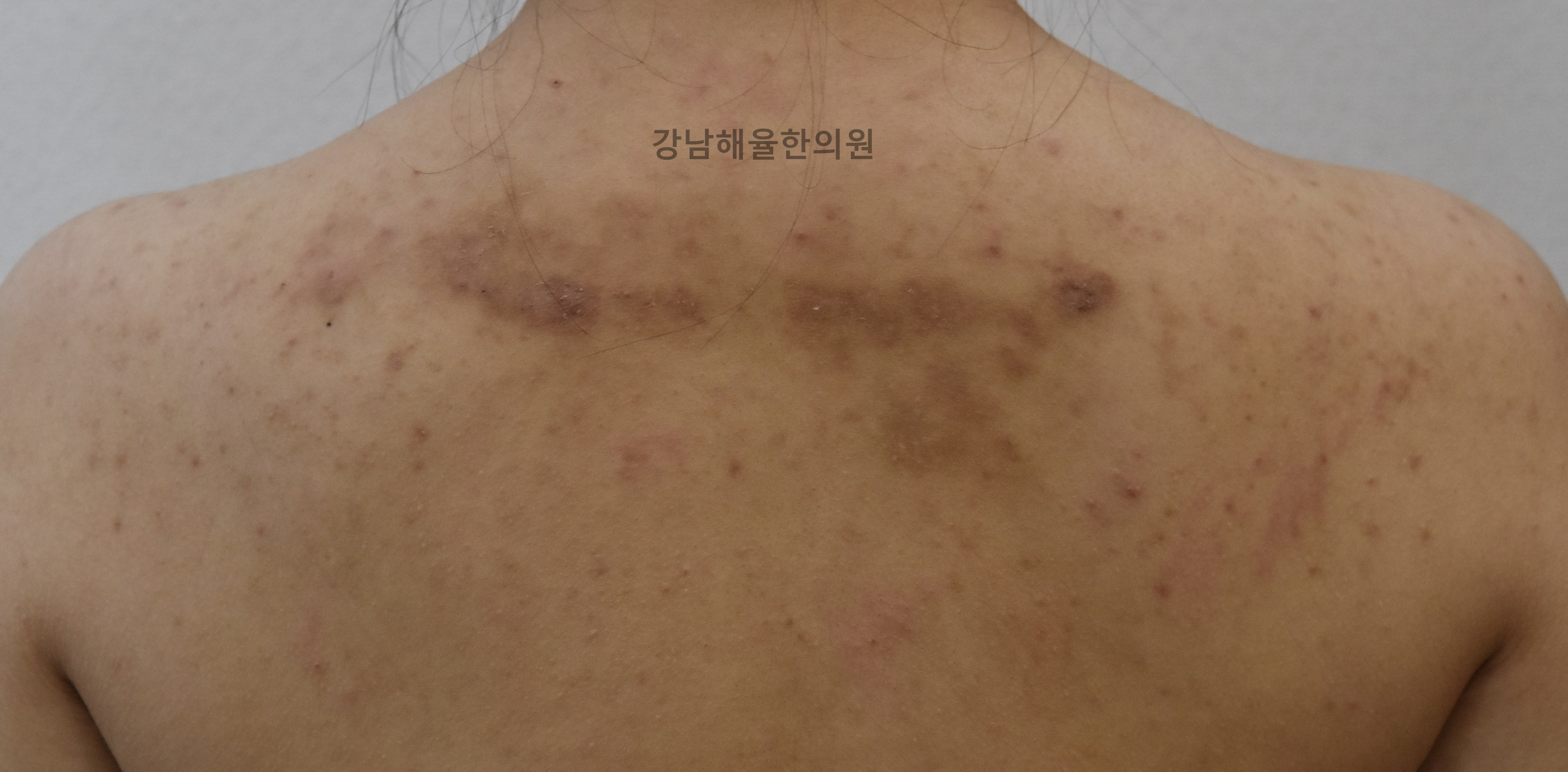 [강남점] 아토피흉터 치료 전 사진 - 해율한의원
