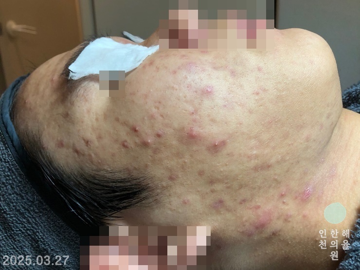 [인천점] 얼굴화농성여드름 치료 전 사진 - 해율한의원