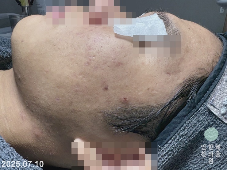 [인천점] 얼굴화농성여드름 치료 후 사진 - 해율한의원