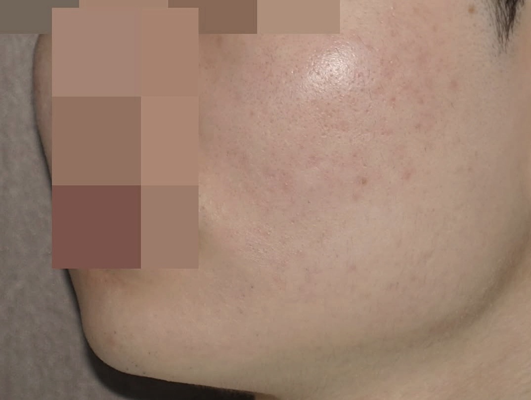 [홍대점] 여드름자국 치료 후 사진 - 해율한의원