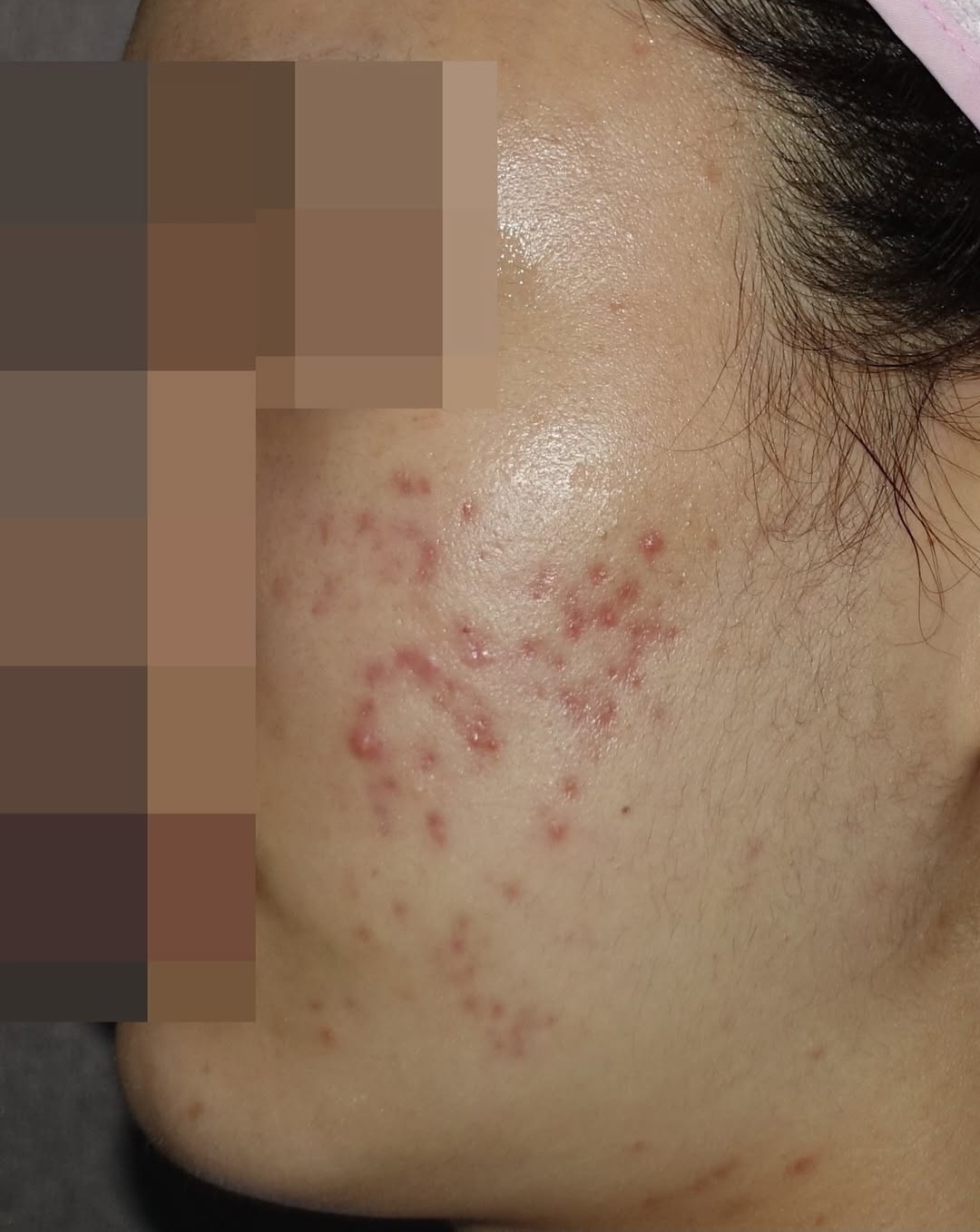 [홍대점] 여드름흉터 치료 전 사진 - 해율한의원