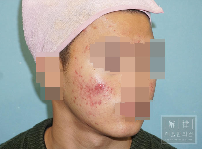 [홍대점] 여드름흉터 치료 전 사진 - 해율한의원