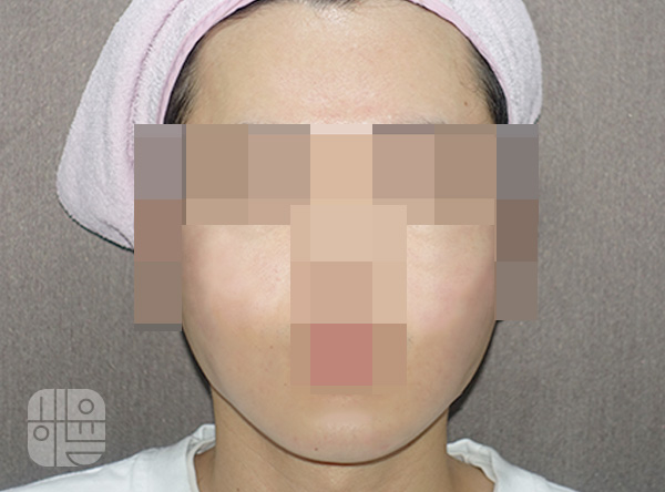 [홍대점] 여드름흉터 치료 후 사진 - 해율한의원