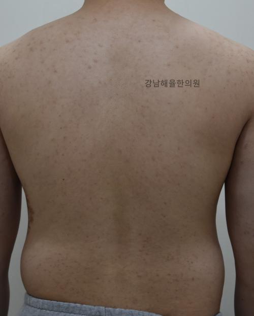 [강남점] 등여드름 치료사례 - 해율한의원