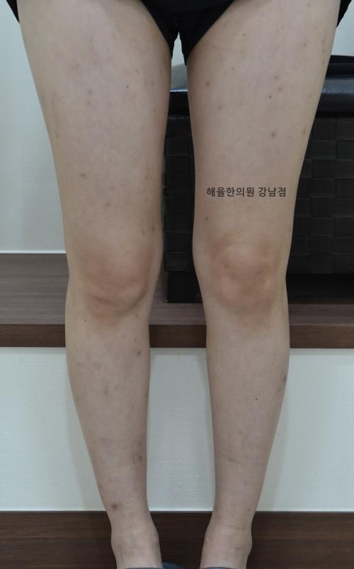 [강남점] 팔다리 색소자국 치료사례 - 해율한의원
