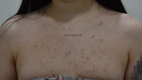 [강남점] 가슴여드름 치료사례 - 해율한의원