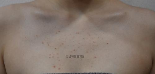 [강남점] 가슴여드름 치료사례 - 해율한의원
