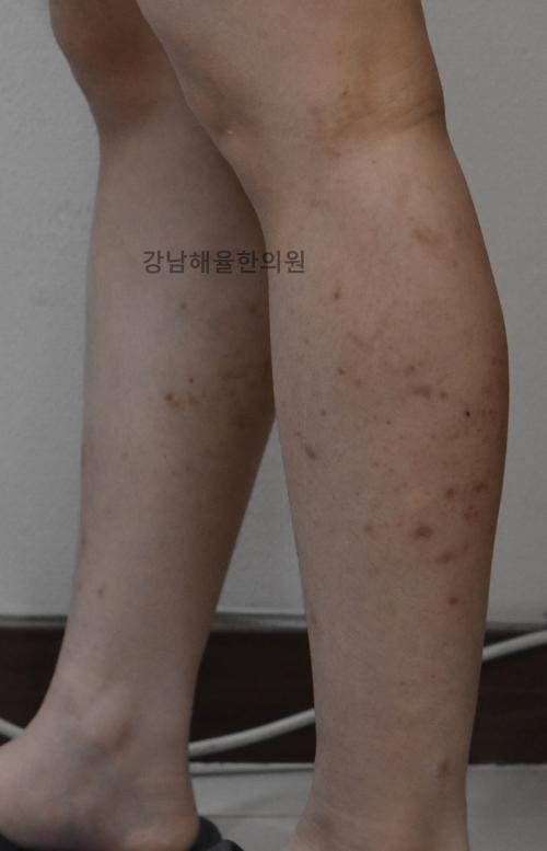 [강남점] 팔다리 색소자국 치료사례 - 해율한의원