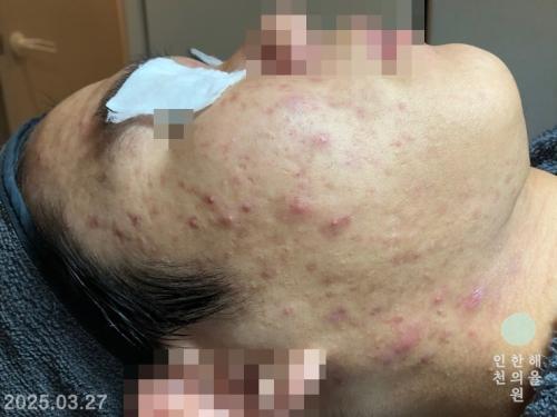 [인천점] 얼굴화농성여드름 치료사례 - 해율한의원