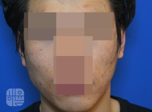 [목동점] 얼굴화농성여드름 치료사례 - 해율한의원