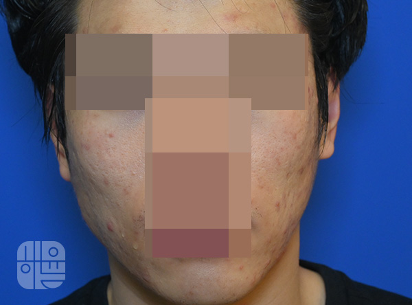 [목동점] 얼굴화농성여드름 치료 전 사진 - 해율한의원